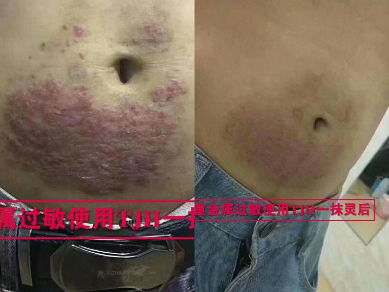 TJH一抹灵抑菌乳膏 诚招全国代理 390代理卖不掉包退