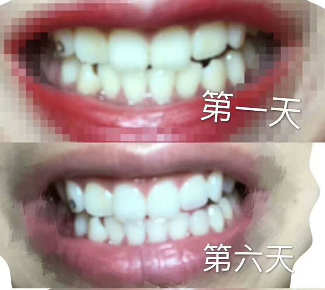 碧缇福抑菌凝胶 美白牙齿的小神器