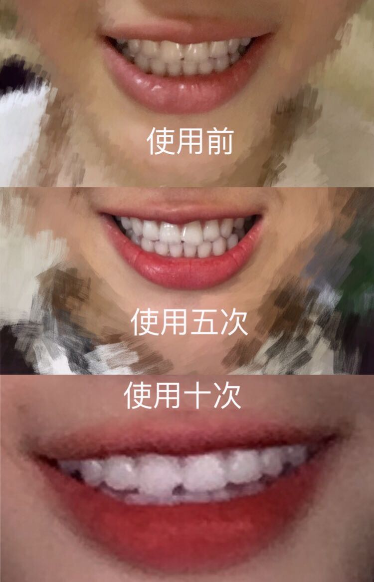 唯爱冷光牙齿美白仪  7-15天见效 无效退款 招代理 手把手教学