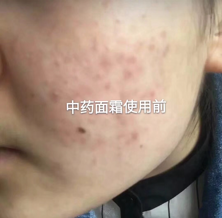 专业祛痘 抗痘 纯中药全效面霜