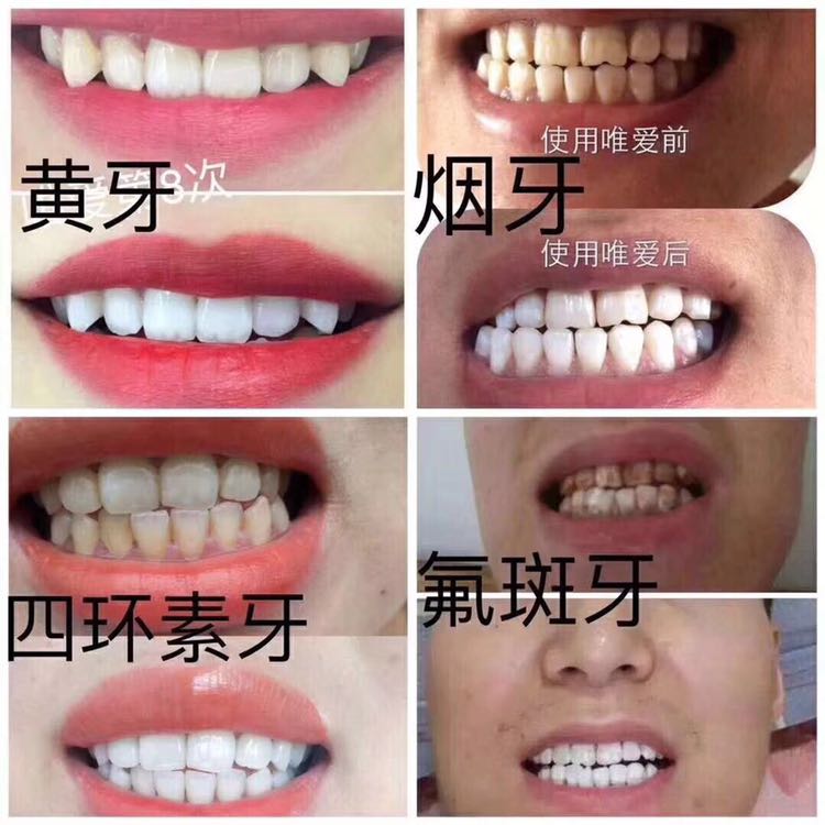 唯爱冷光美牙仪
