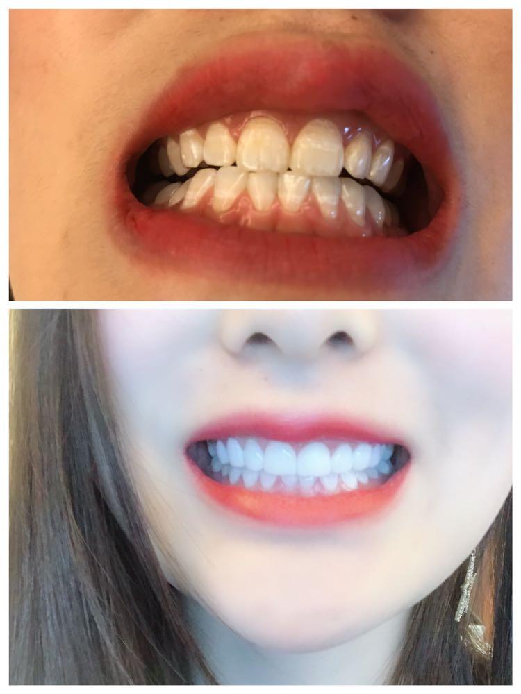牙齿微雕美白，树脂贴面，瓷贴面