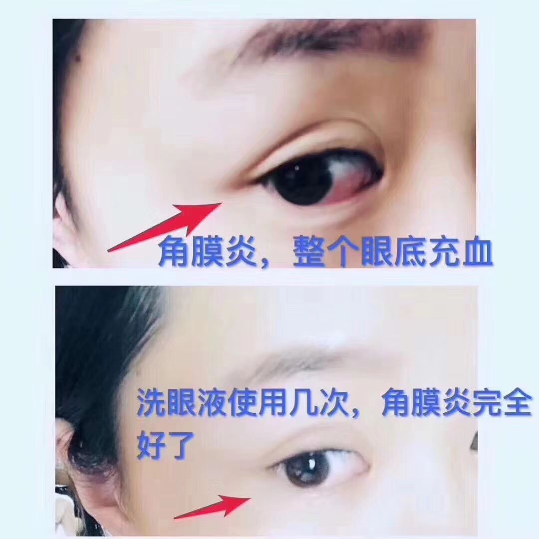 国企微商，福瑞达心生爱目洗眼液