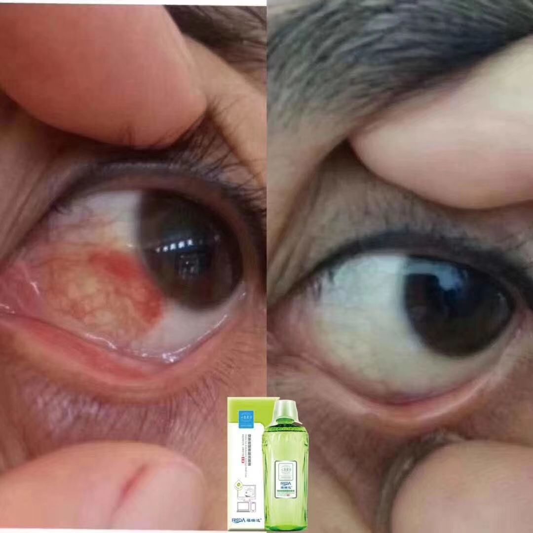 国企微商，福瑞达心生爱目洗眼液