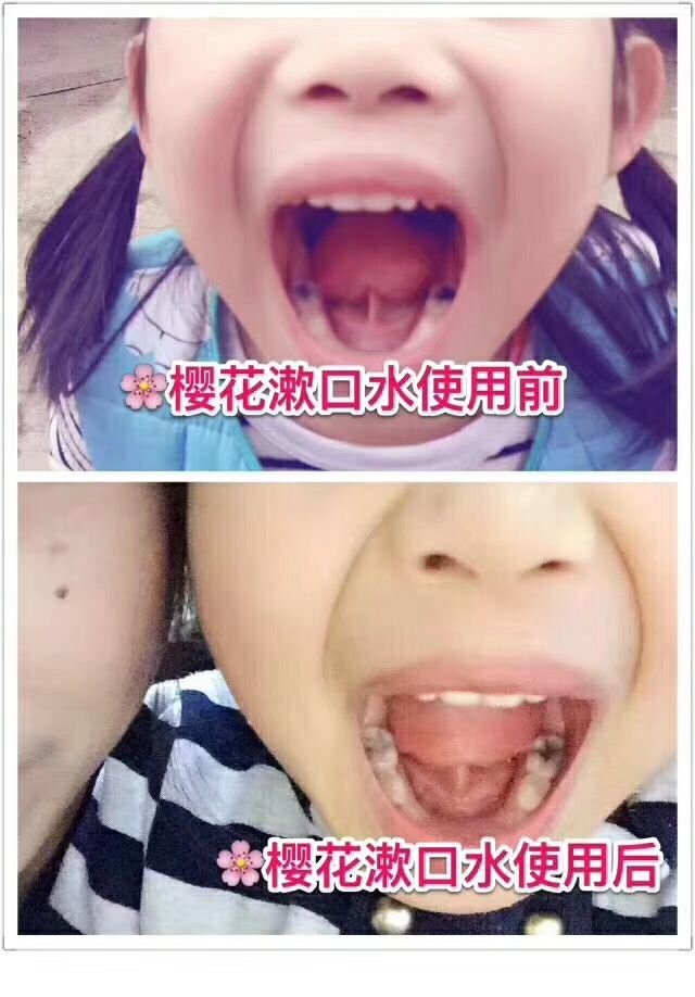 酵素樱花漱口水 蛀牙、黑牙通通变好牙
