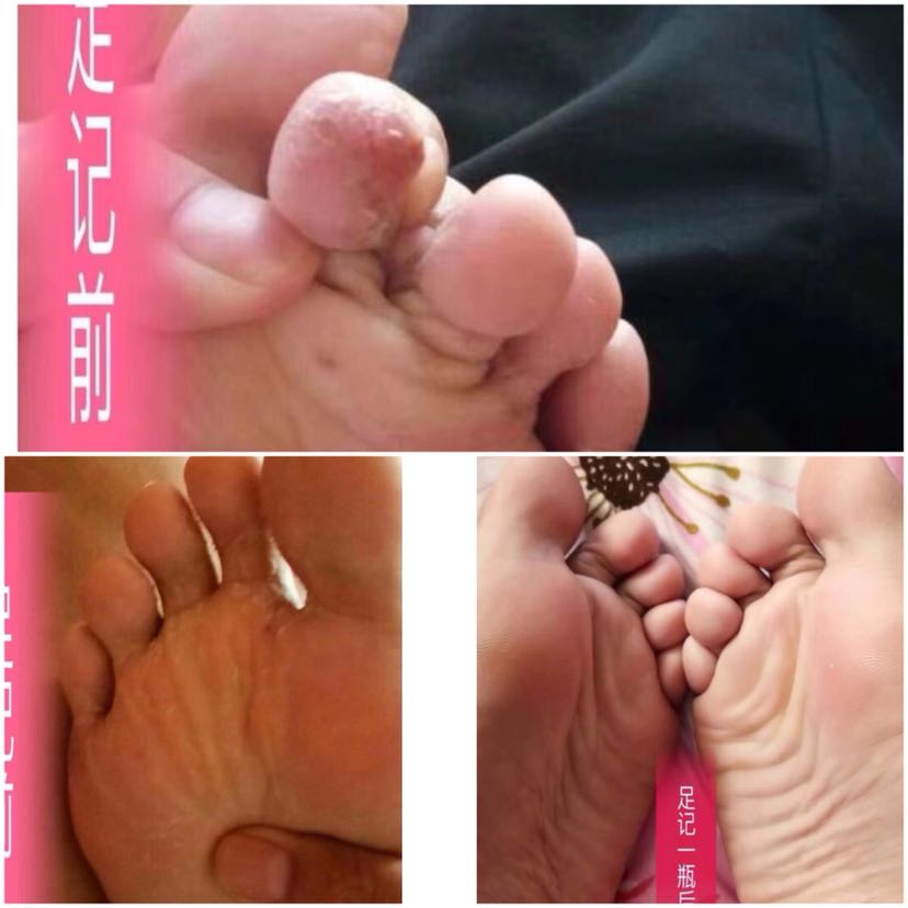专业治脚气，一瓶只需35