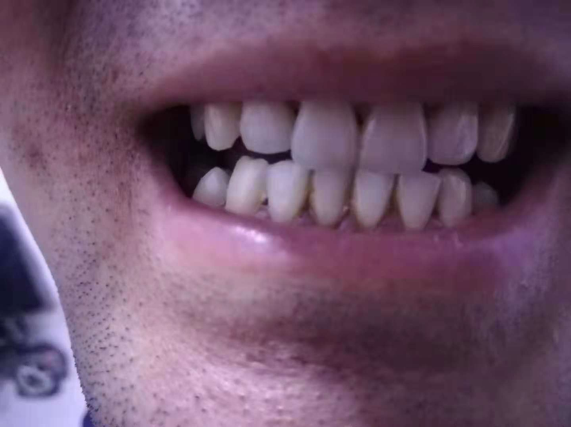 碧缇福清洁抑菌凝胶套装（美牙仪）