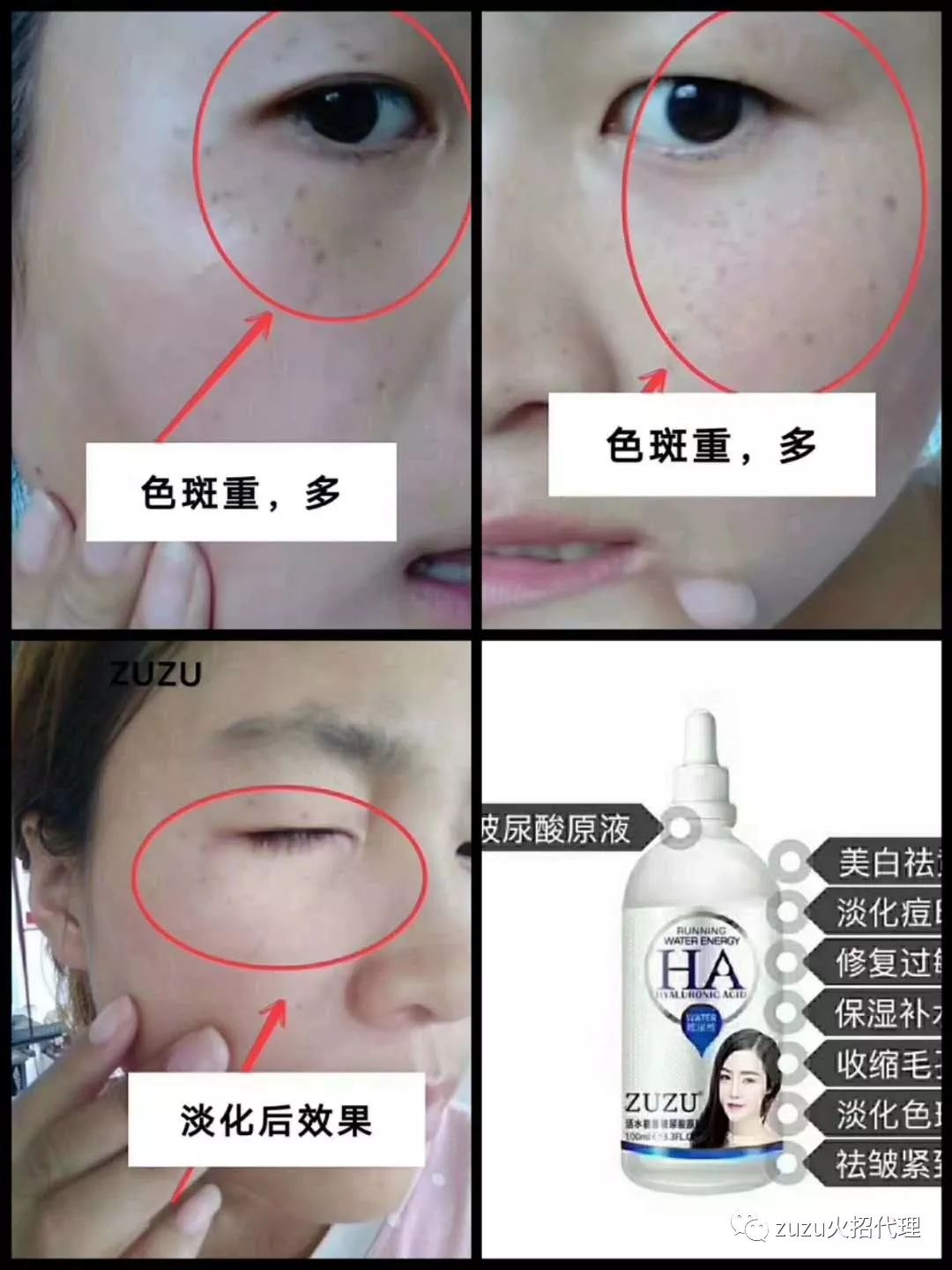 zuzu玻尿酸 想要改变自己的加我哟