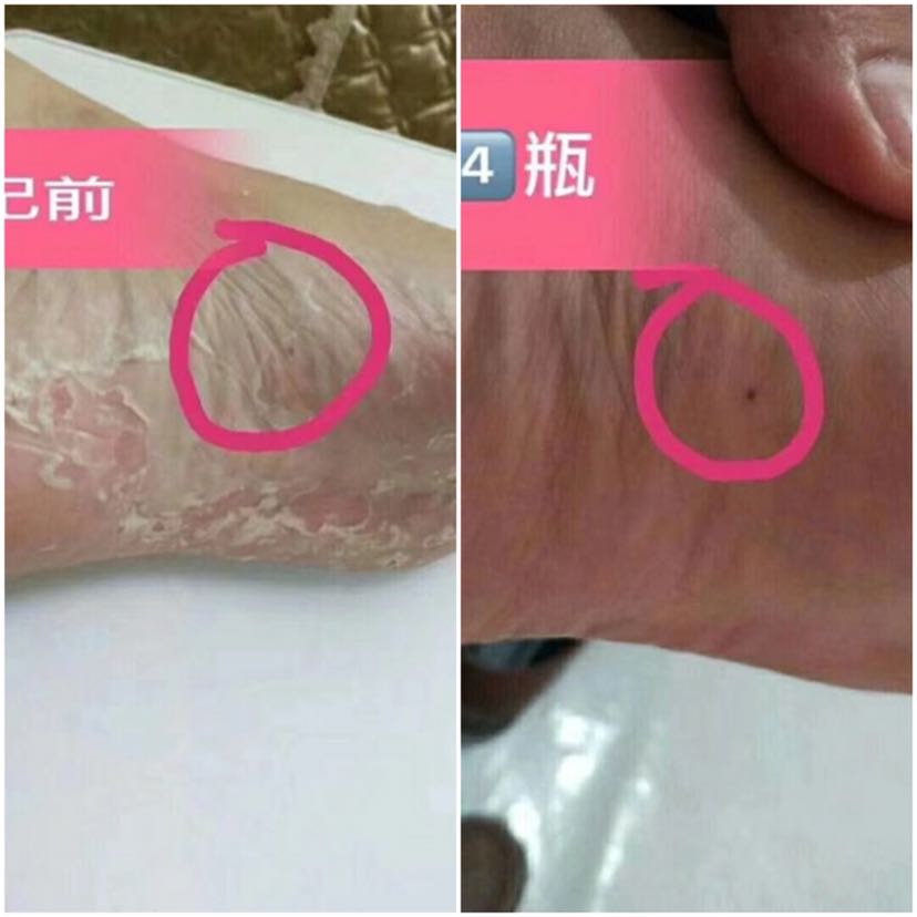 专业治脚气，一瓶只需35
