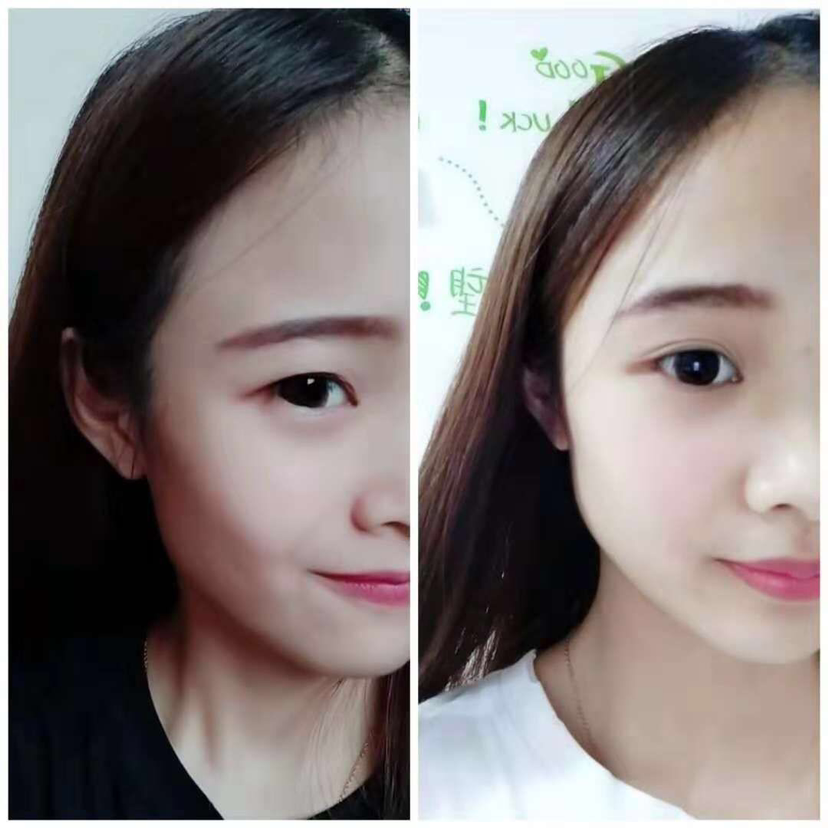一双眼拯救一张脸，七天按摩成双眼皮，看完少走一些弯路♥️