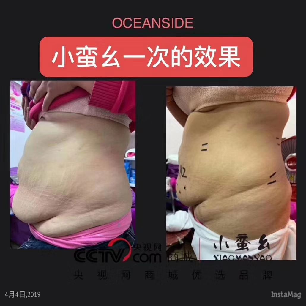 小蛮幺懒人抹抹瘦