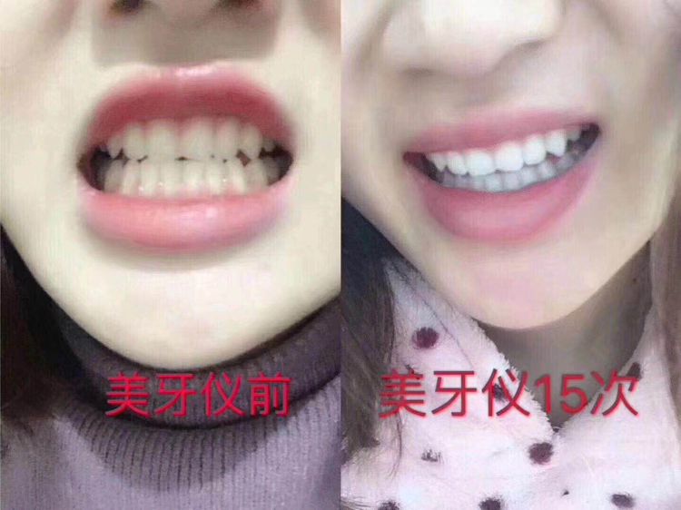 ❥认真坚持用过碧缇福美牙仪的人从来没有一个让我失望的[呲牙]