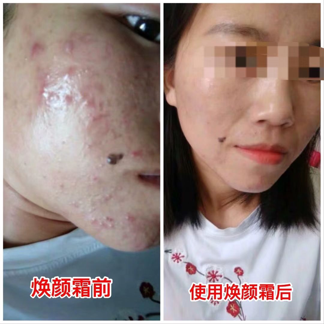 欧月美纯中药焕颜霜，祛斑祛痘，修复过敏