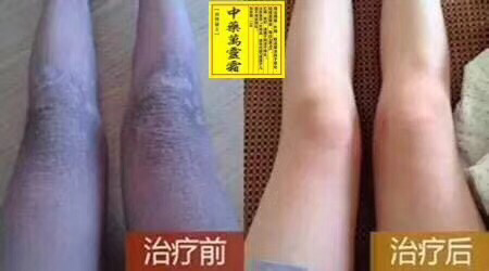 中药万灵霜-治愈各种皮肤问题 各种癬 纯中药做成 祖传秘方