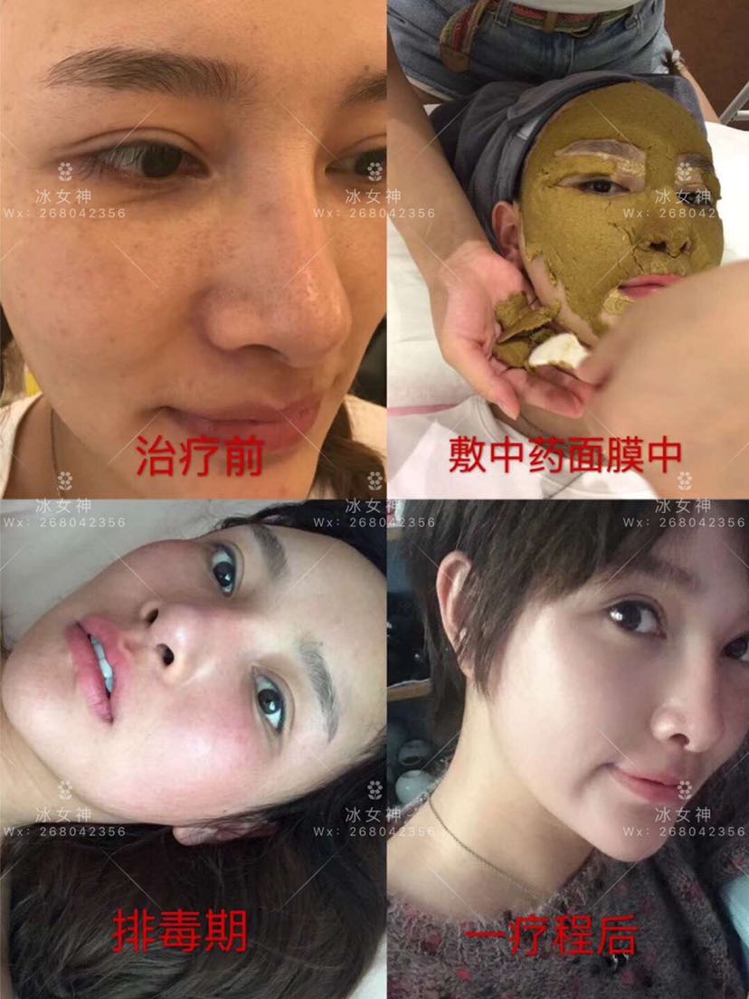 纯中药面膜：祛斑、祛痘、美白