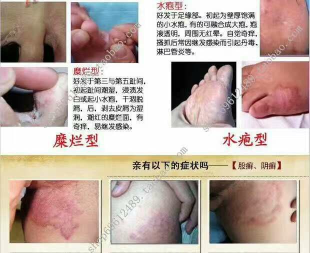 专治脚气，灰指甲，水泡发痒脱皮，各种癣症，不复发！