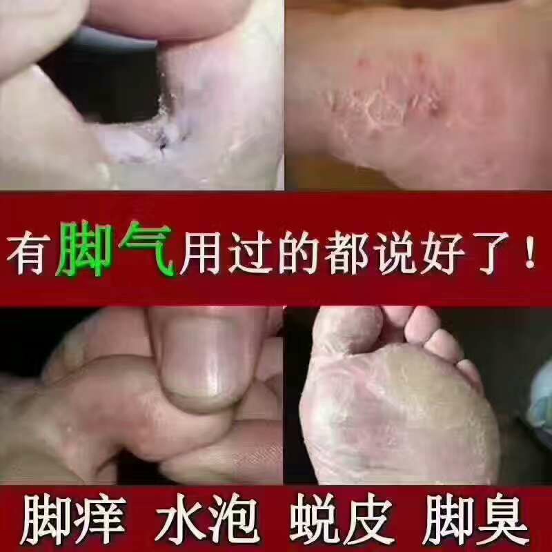 专治脚气，灰指甲，水泡发痒脱皮，各种癣症，不复发！