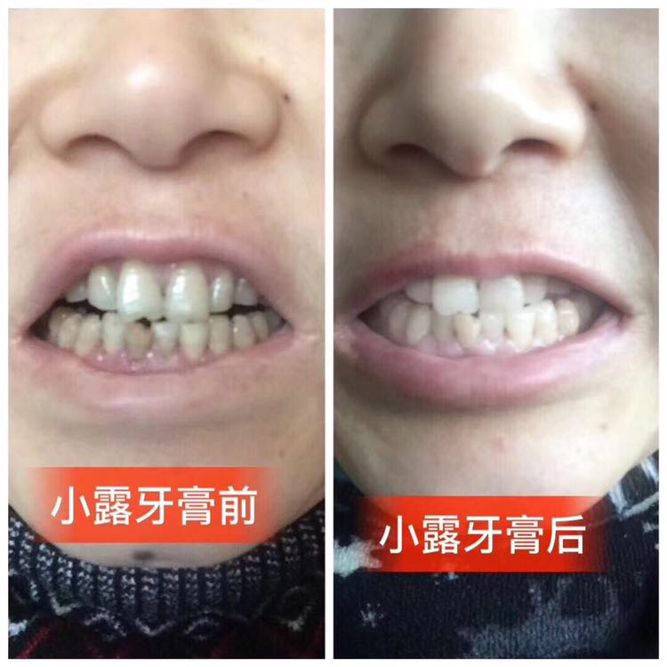 15天牙齿美白两个度