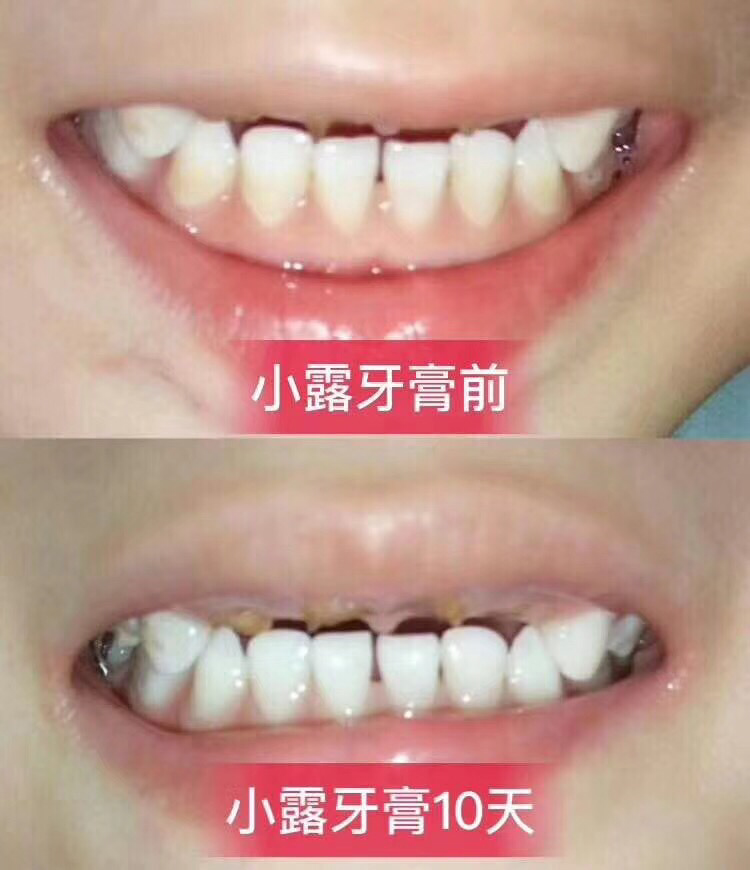 15天牙齿美白两个度