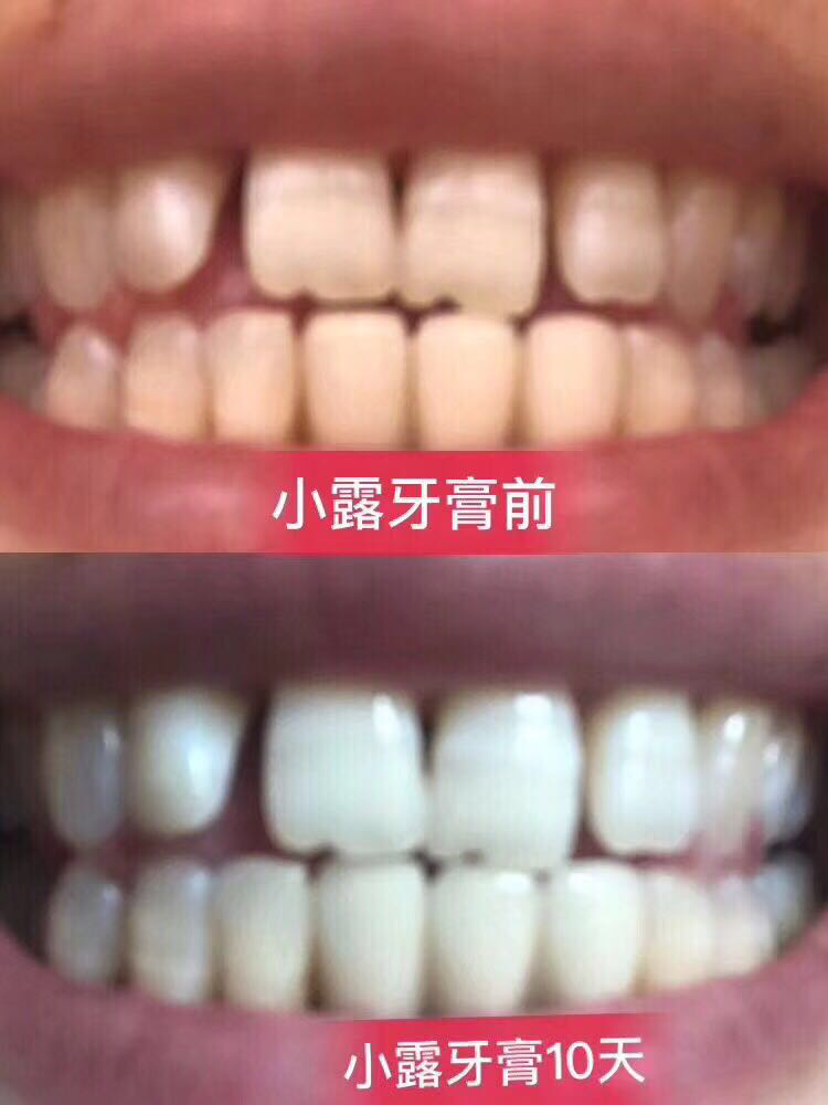 15天牙齿美白两个度
