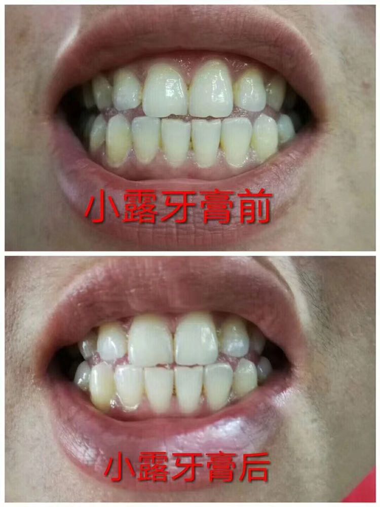 15天牙齿美白两个度