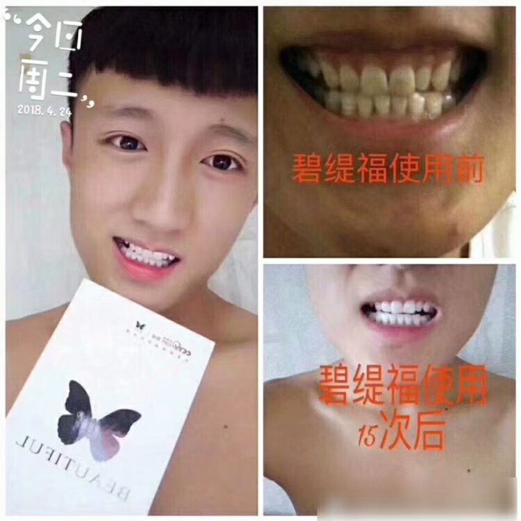美牙仪能让你10-15天从内到外置换出牙齿附着色素也就变白了