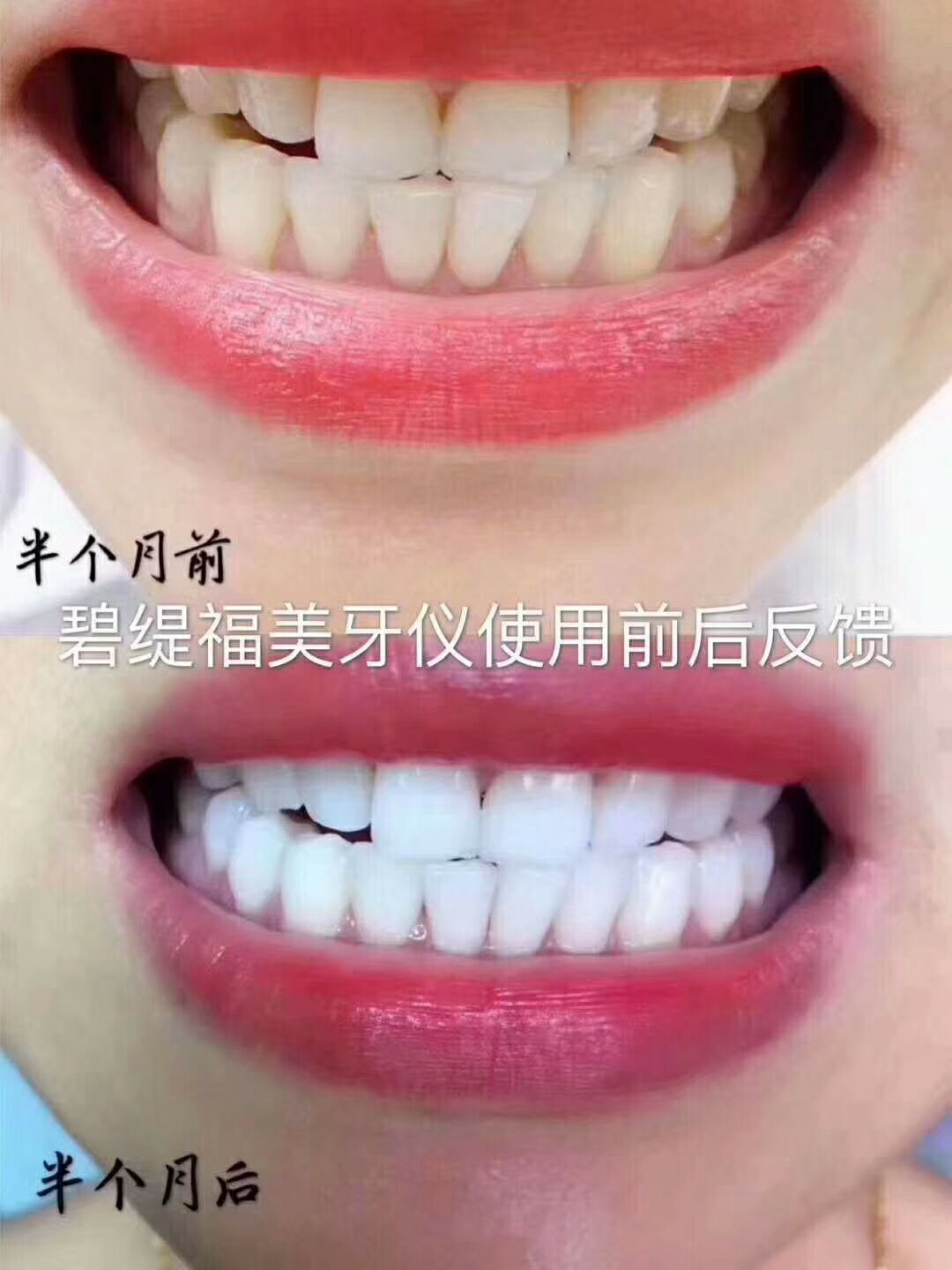 碧缇福冷光美牙仪
