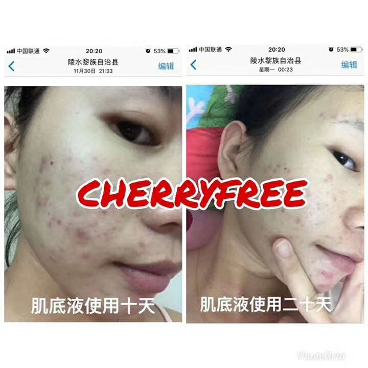 祛痘➕️淡痘印➕️抗皱➕️补水➕️抗衰老