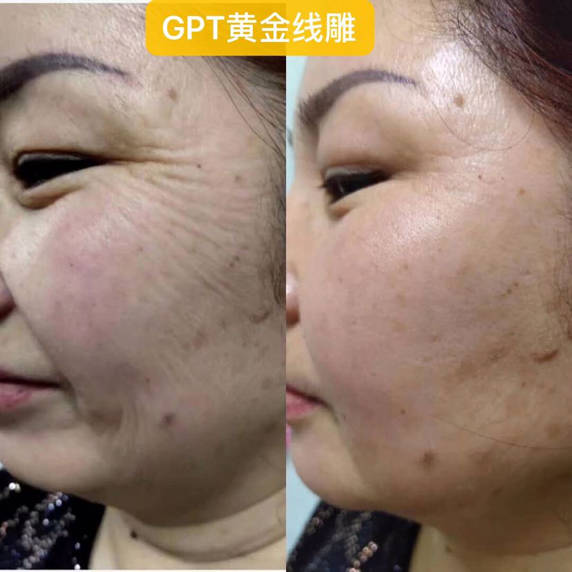 纤本堂拍拍瘦，一分钟立瘦三厘米。GPT黄金线雕，5分钟去皱