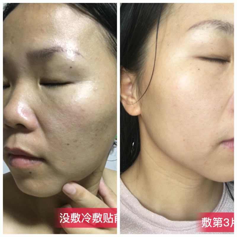冷敷贴➕凝胶套盒 焕肤计划  改善痘痘