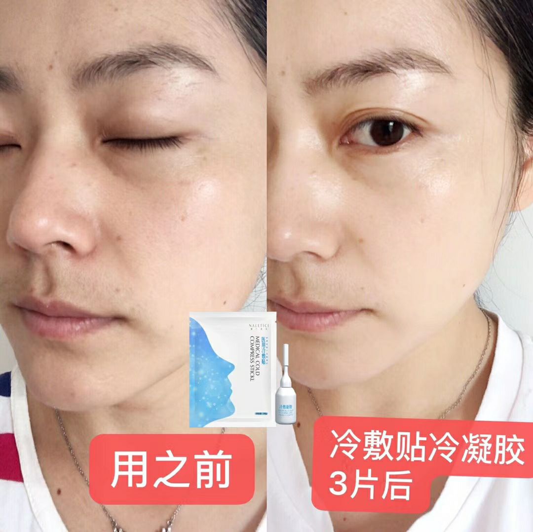 冷敷贴➕凝胶套盒 焕肤计划  改善痘痘