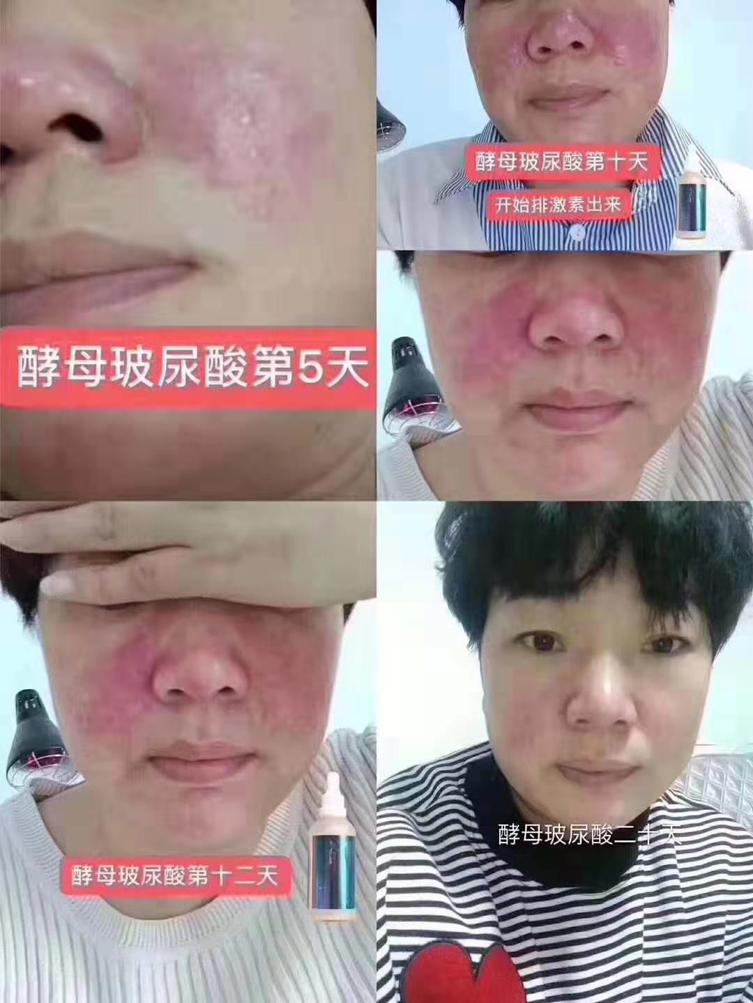 酵母玻尿酸♥孕妇小孩都可以用。