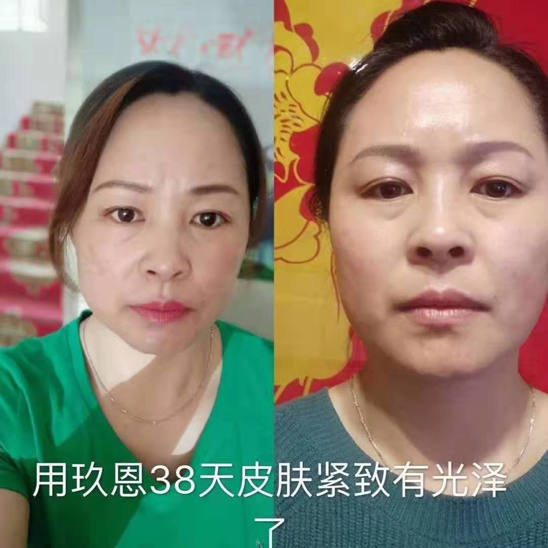 彻底改善皱纹红血丝，痘痘，痘印，黑眼圈，色斑眼袋，十分钟见效