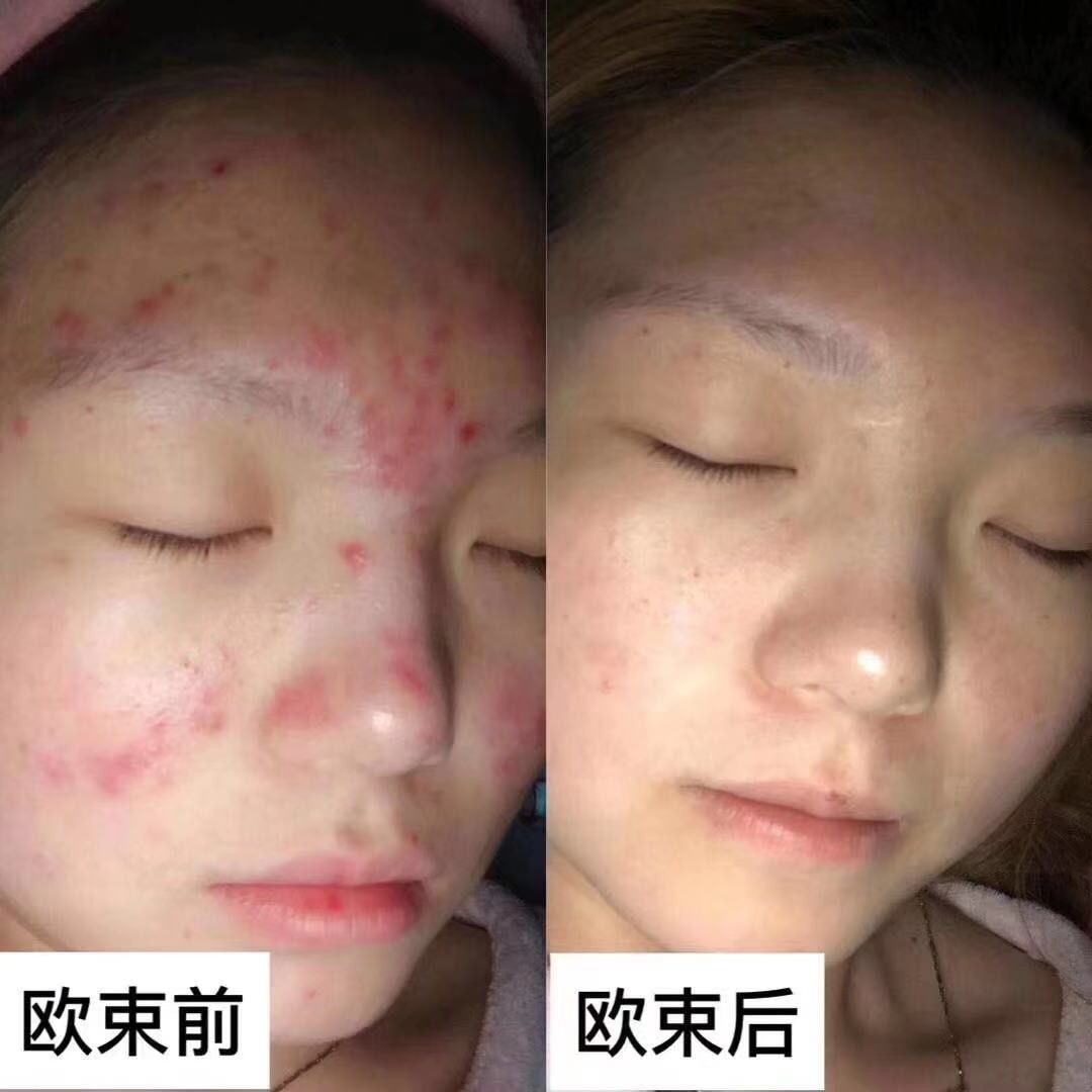 痘痘肌有救啦