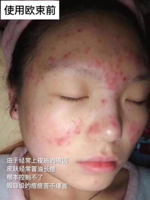 痘痘肌有救啦