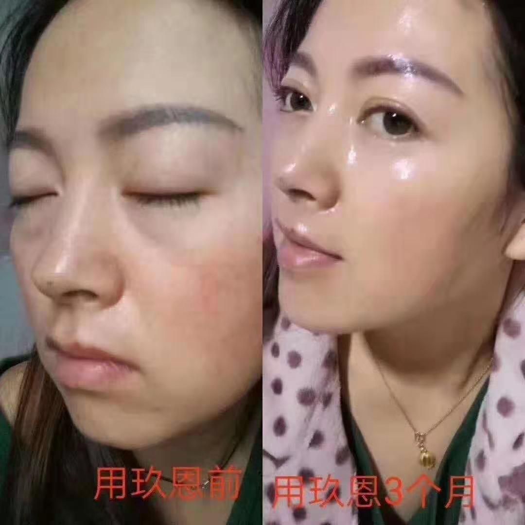 彻底改善皱纹红血丝，痘痘，痘印，黑眼圈，色斑眼袋，十分钟见效