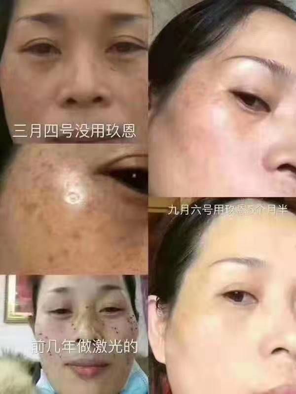 彻底改善皱纹红血丝，痘痘，痘印，黑眼圈，色斑眼袋，十分钟见效
