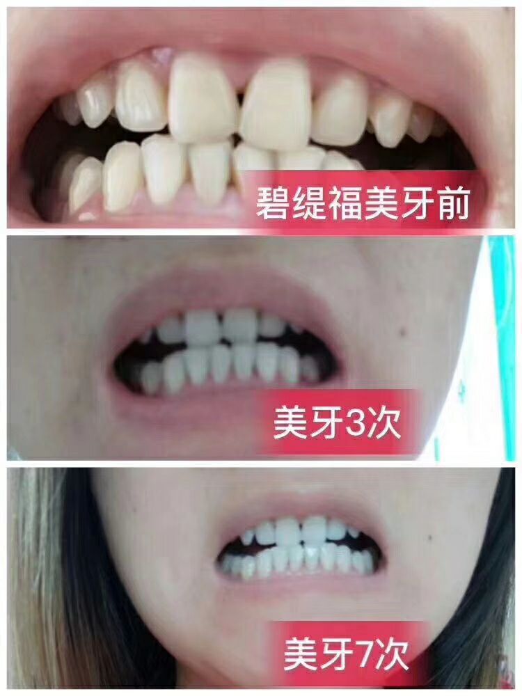 碧缇福美牙仪 7天见效15天无效退款