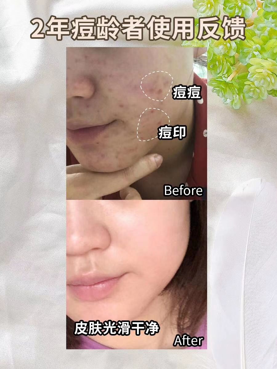 净颜祛痘套组C