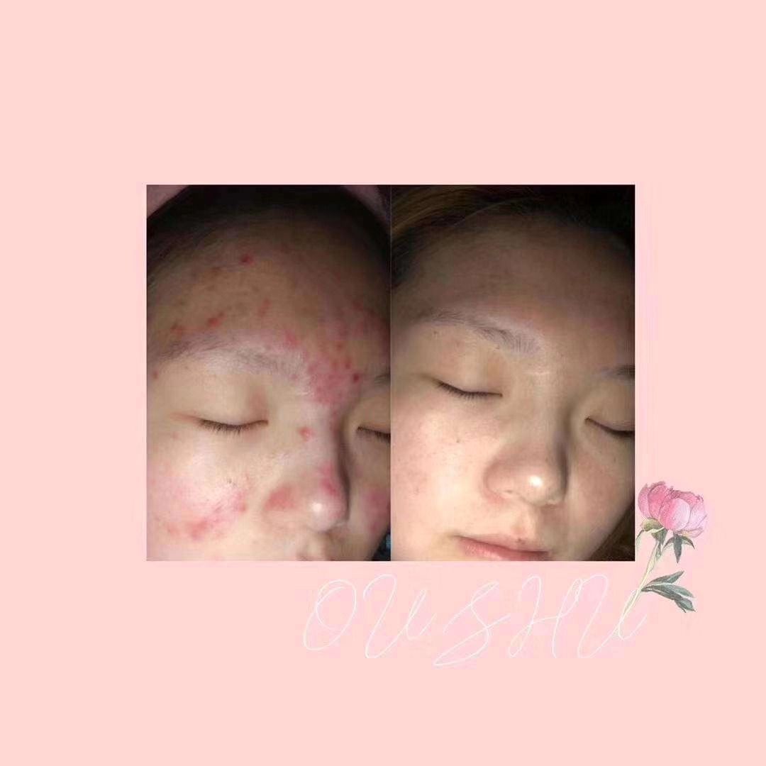 美白护肤，去痘痘肌，敏感肌，干性皮肤等待