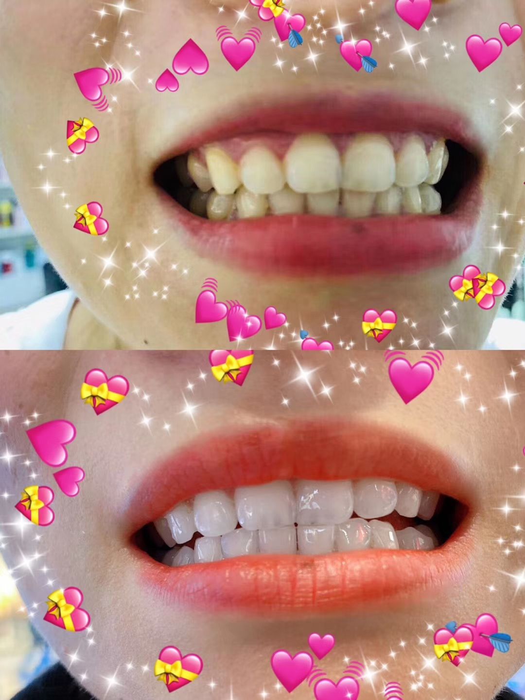 炫方冷光美牙
