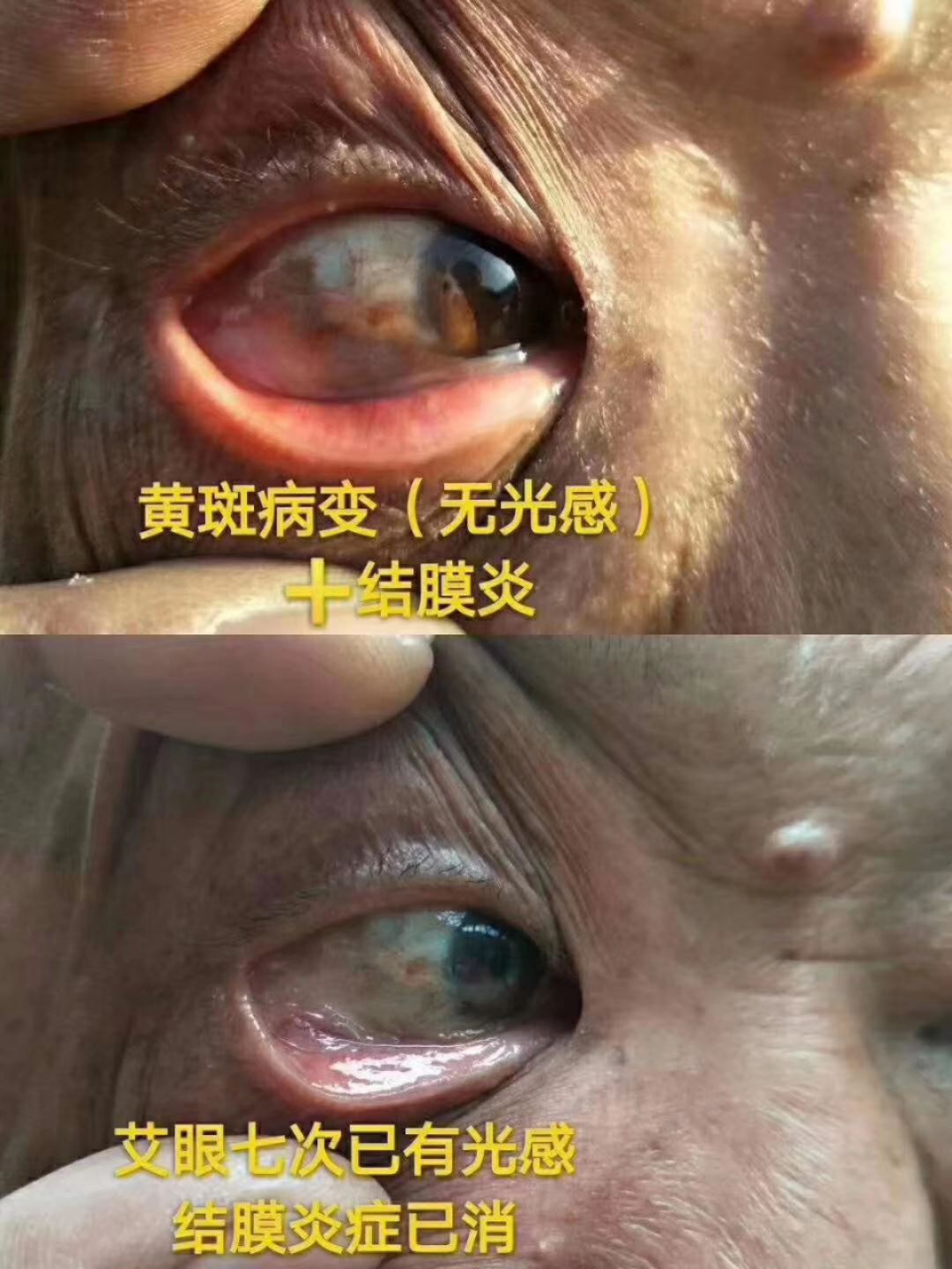 眼部艾灸，调理眼部疾病近视斜视弱视散光等眼疾