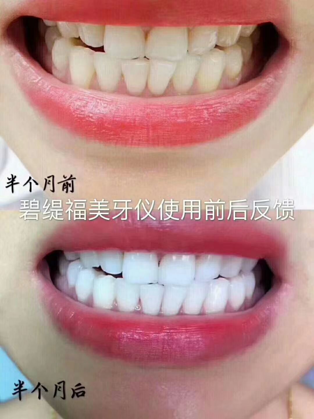 碧缇福美牙仪 七天还你大白牙