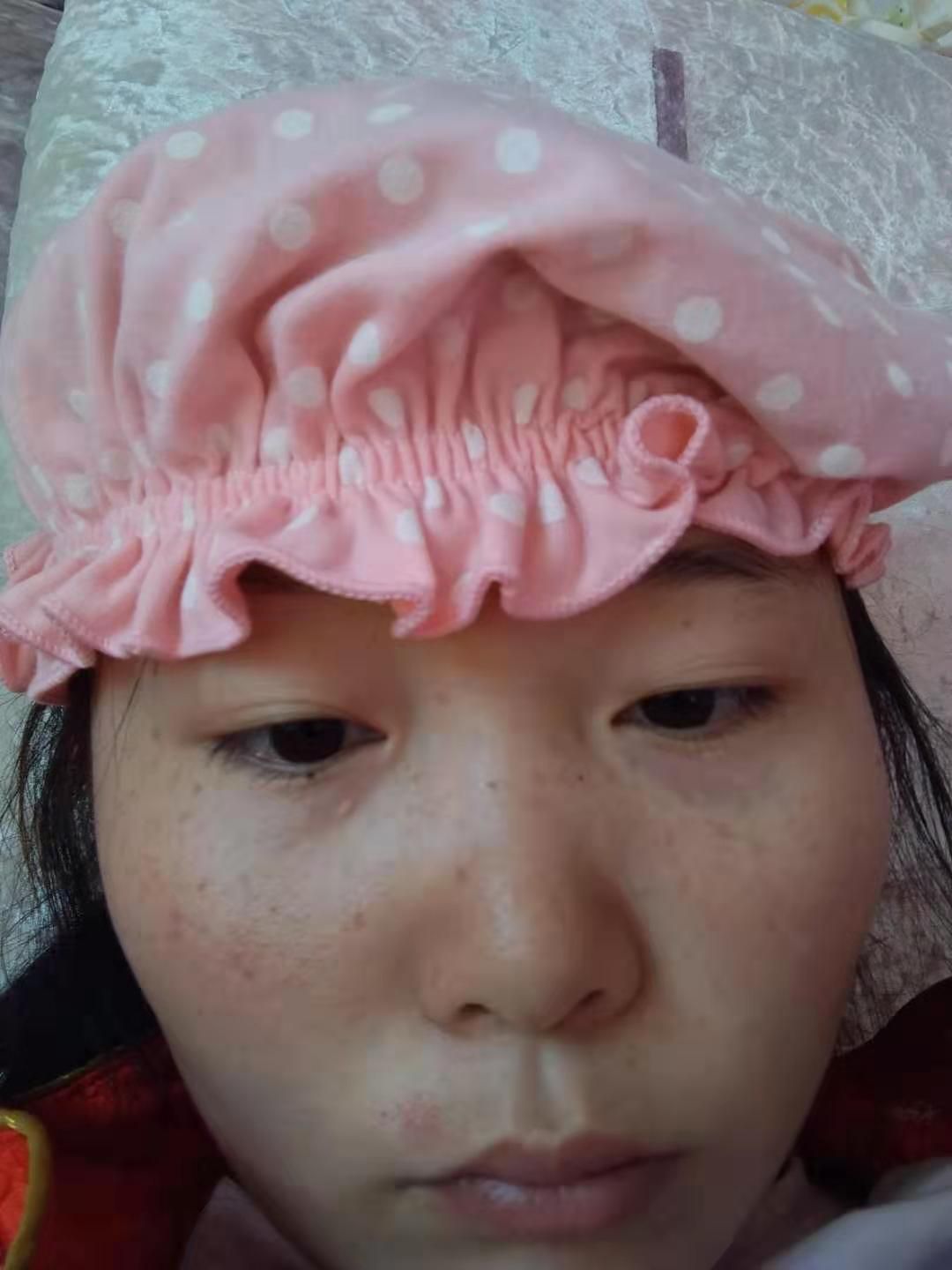 温士美化妆品美白、祛斑、祛痘、祛痘印、无效退