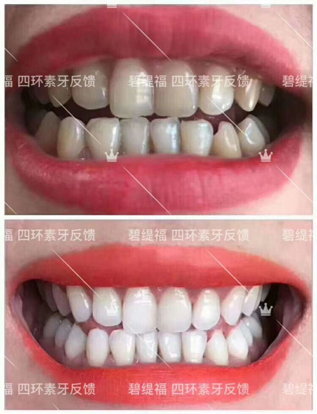 碧缇福美牙仪 七天还你大白牙