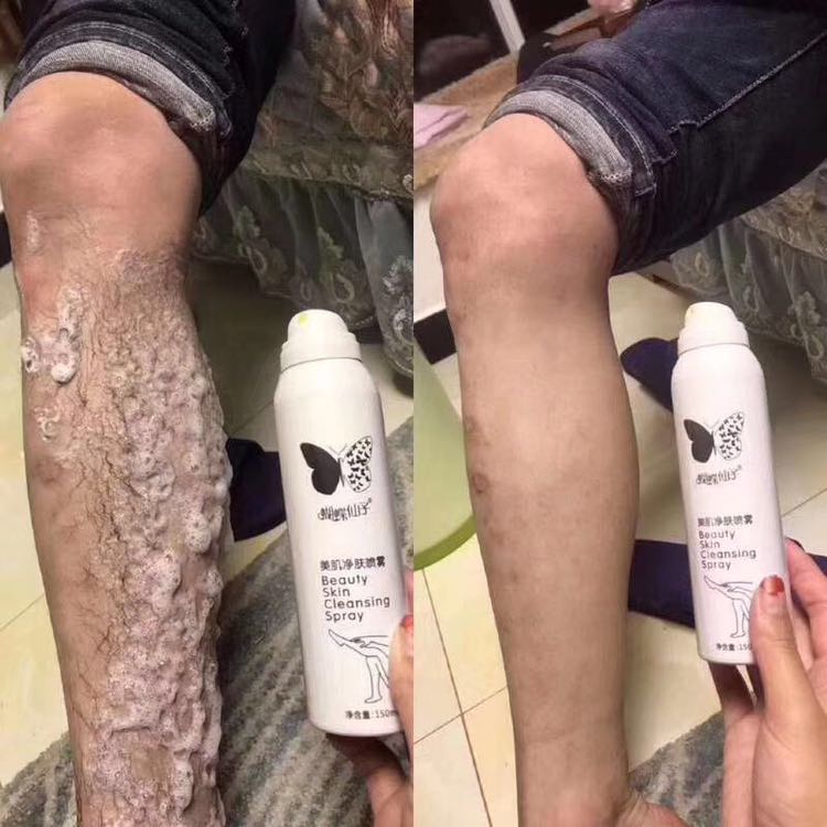 蝴蝶仙子脱毛喷雾