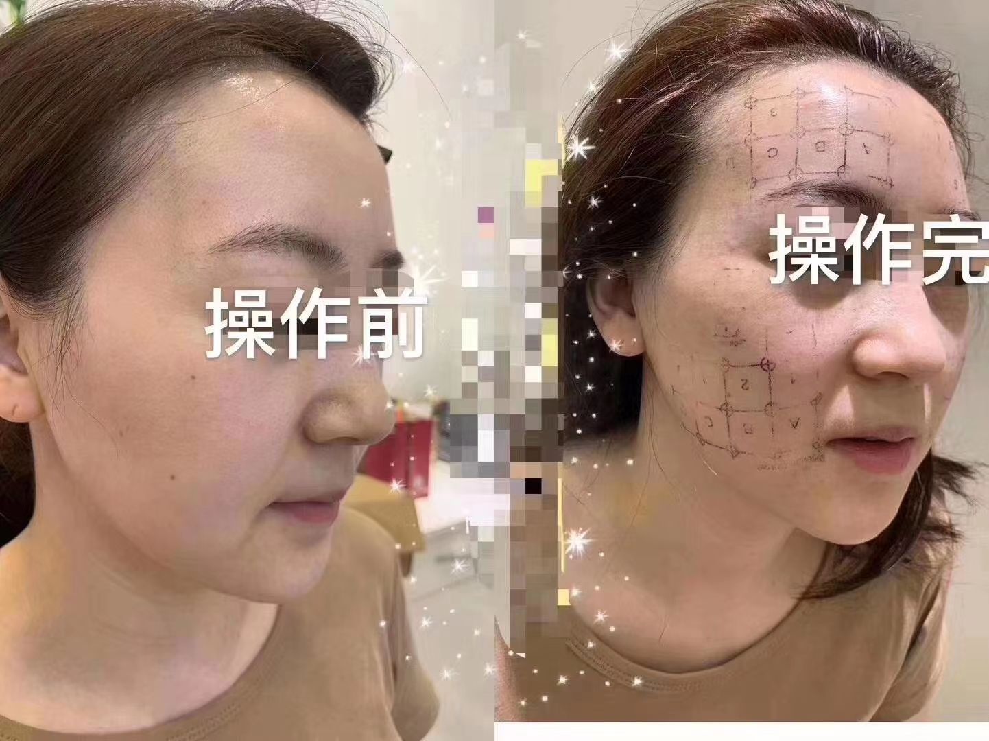地五代热玛吉抗衰项目免费下店合作，755蜂巢皮秒免费下店合