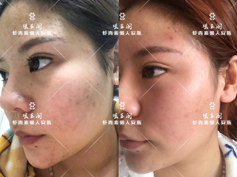 瑶玉阁虾青素懒人安瓶精华