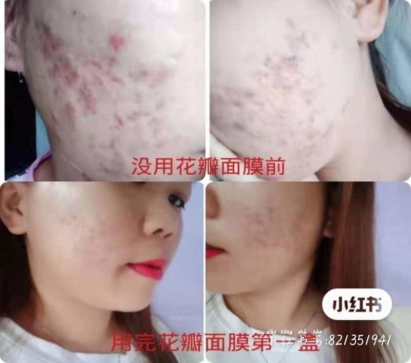 花瓣面膜补水保湿美白女正品冰膜祛痘淡化痘印淡斑网红软膜粉