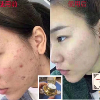 想要祛痘痘的可以加我微信,有实体店，两盒无效退款